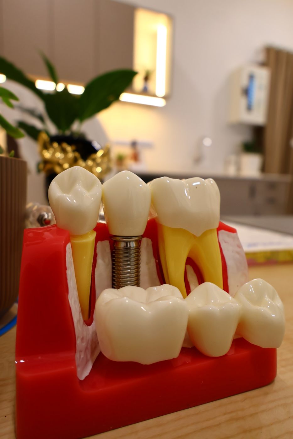 Dental implant and crown model